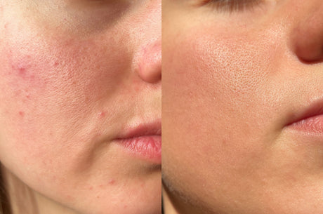 How To Really Cure Acne & Congestion