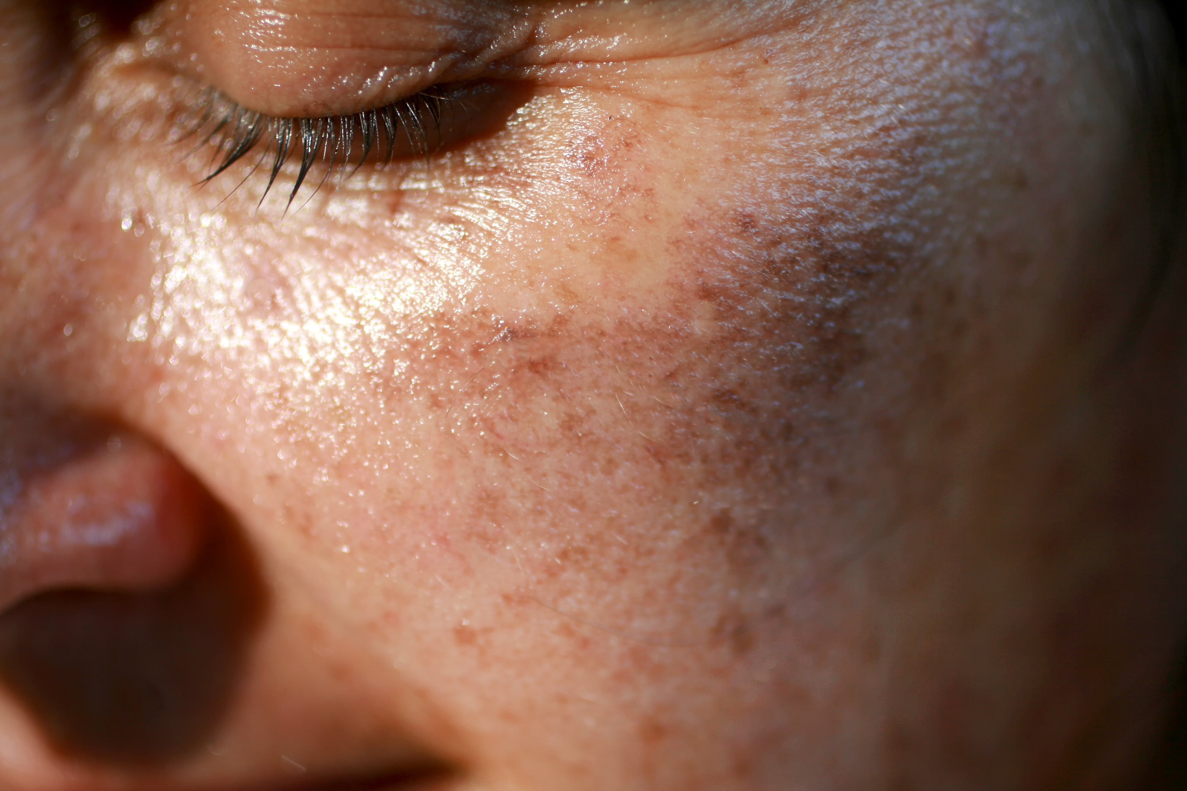 How to really get rid of sun pigmentation!