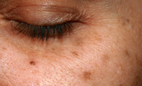 It’s all about pigmentation...