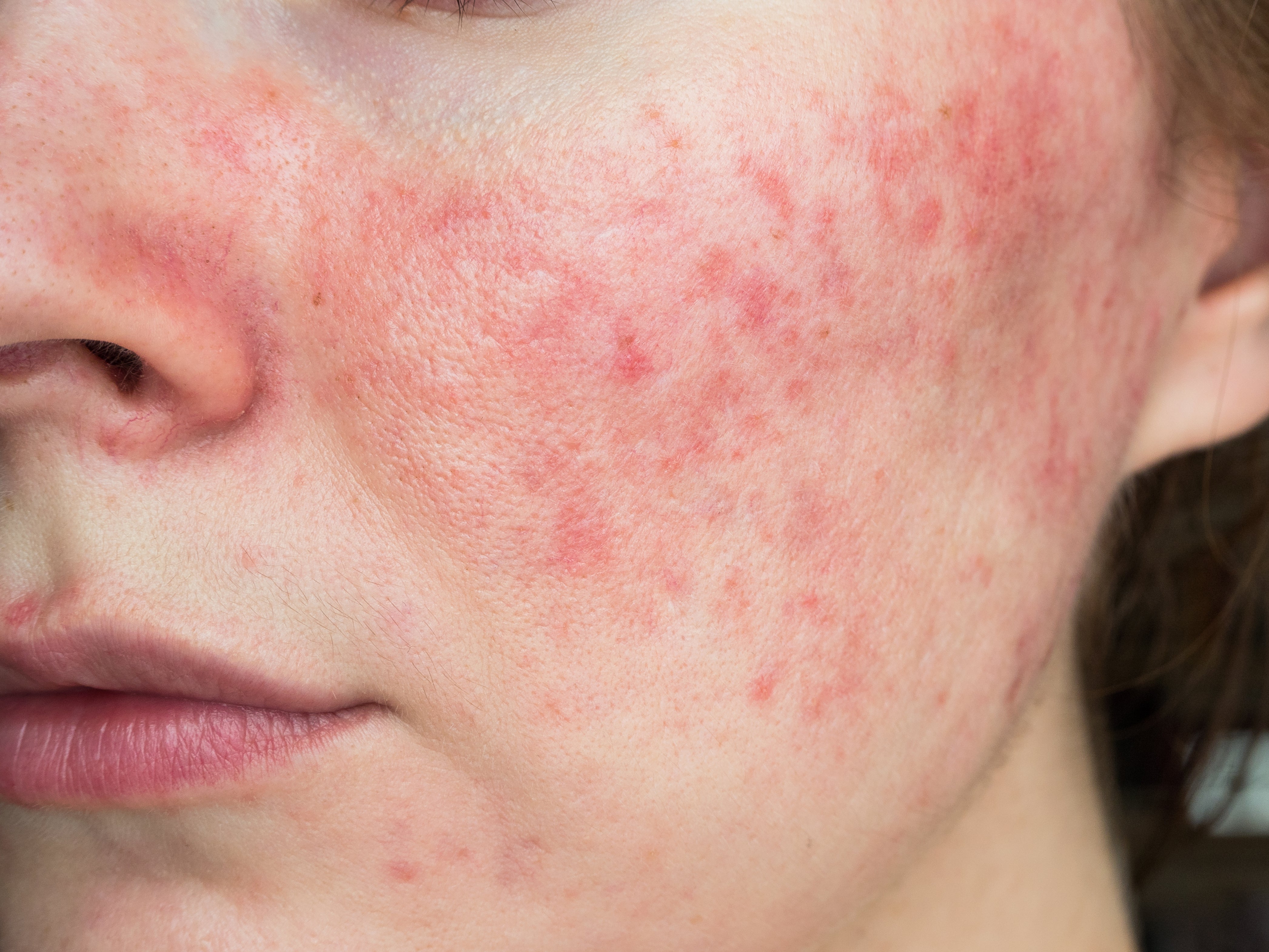 Understanding Rosacea and How to Treat it