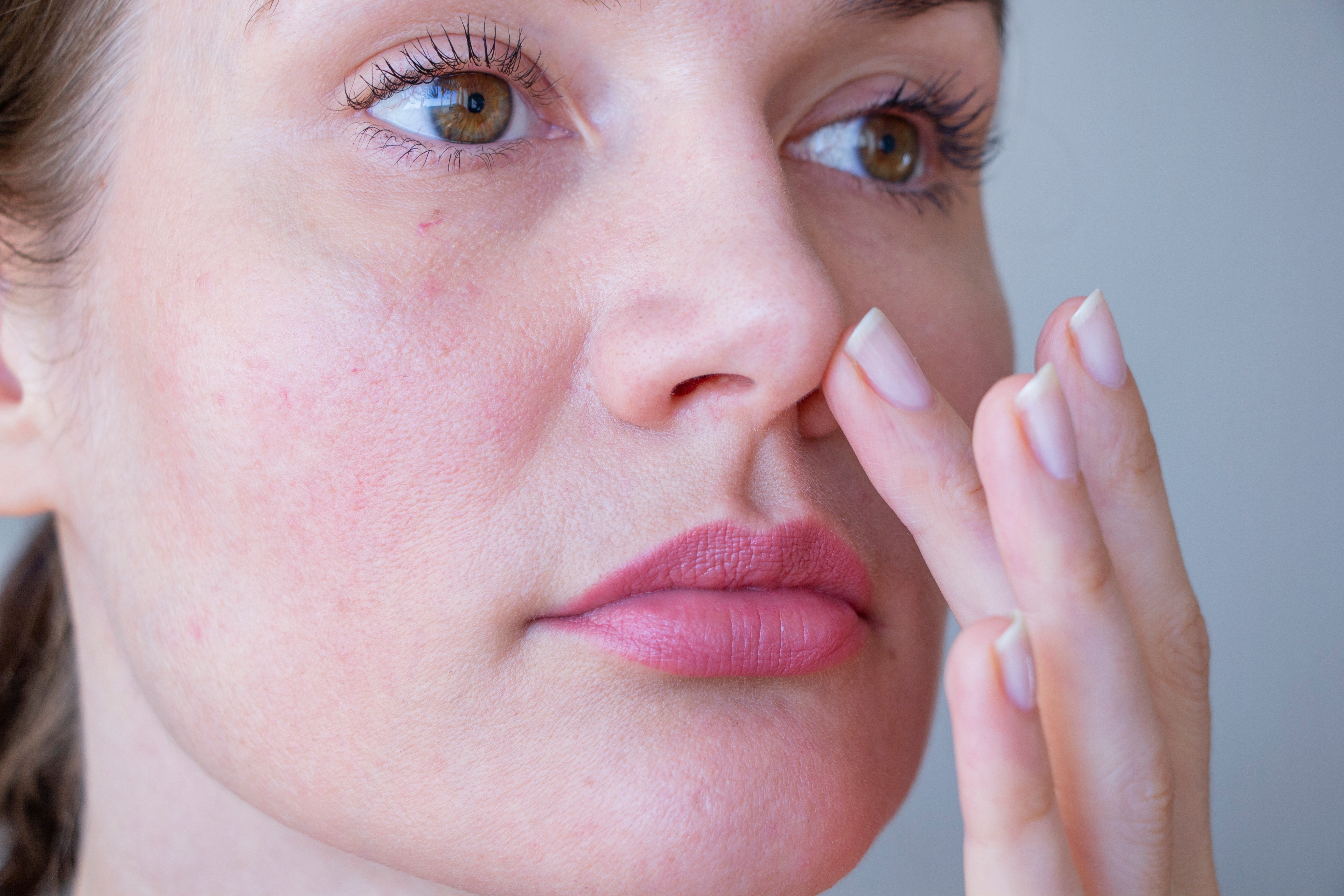 Understanding Rosacea and How to Treat it