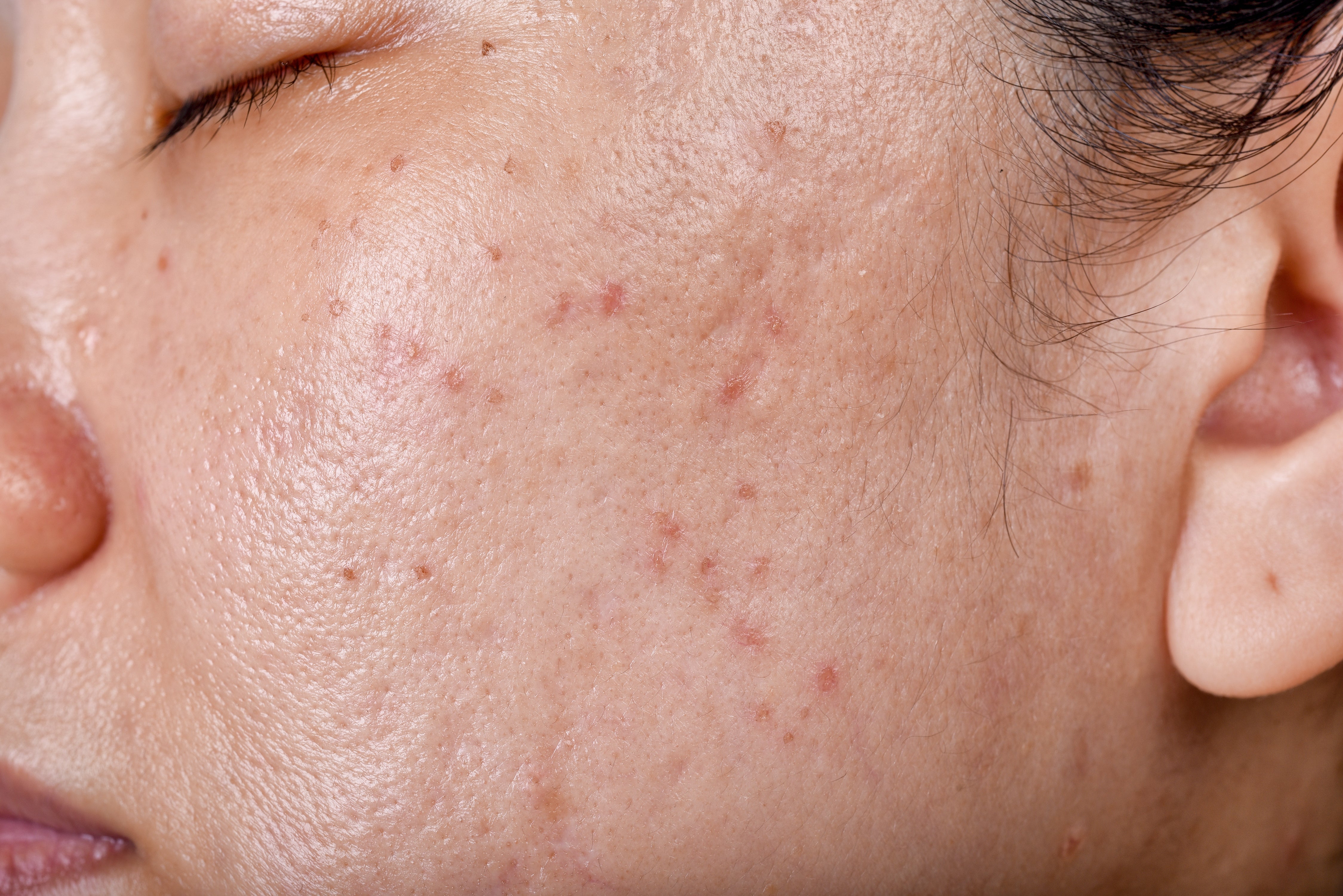 How to treat acne in the summer