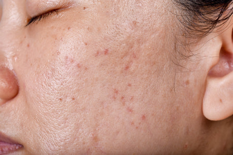 How to treat acne in the summer