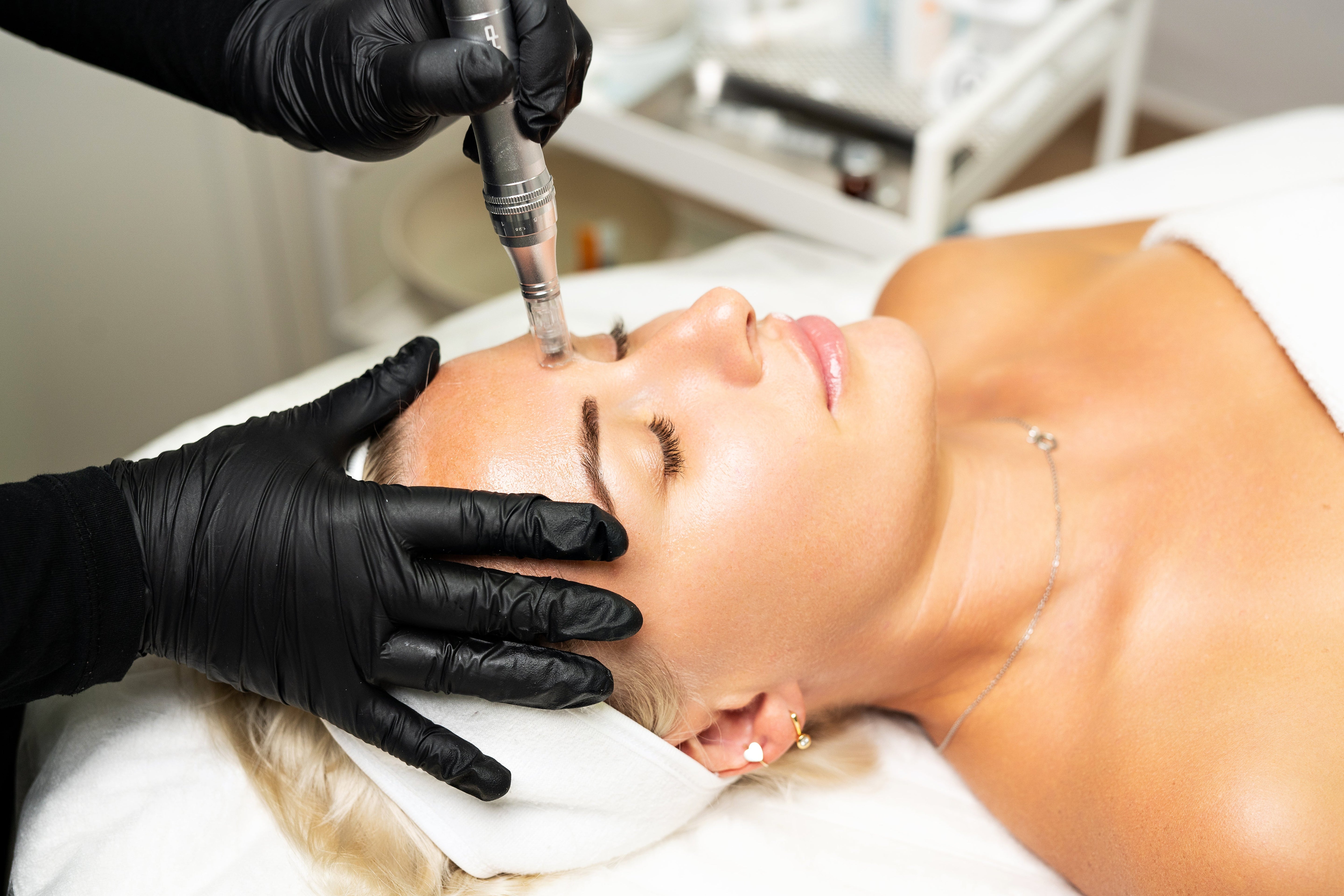 How does Microneedling work? Everything you need to know.