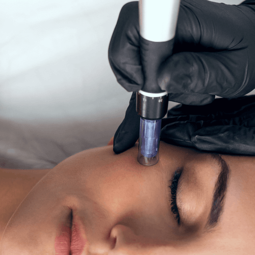 How does Microneedling work? Everything you need to know.