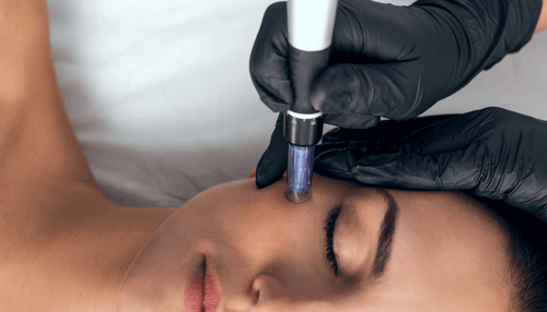 How does Microneedling work? Everything you need to know.