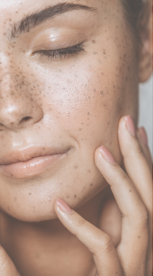 Pigmentation and Brightening Skin Concern